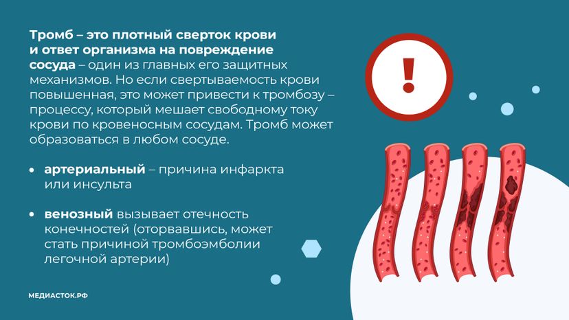 Тромбоз горизонталь 03