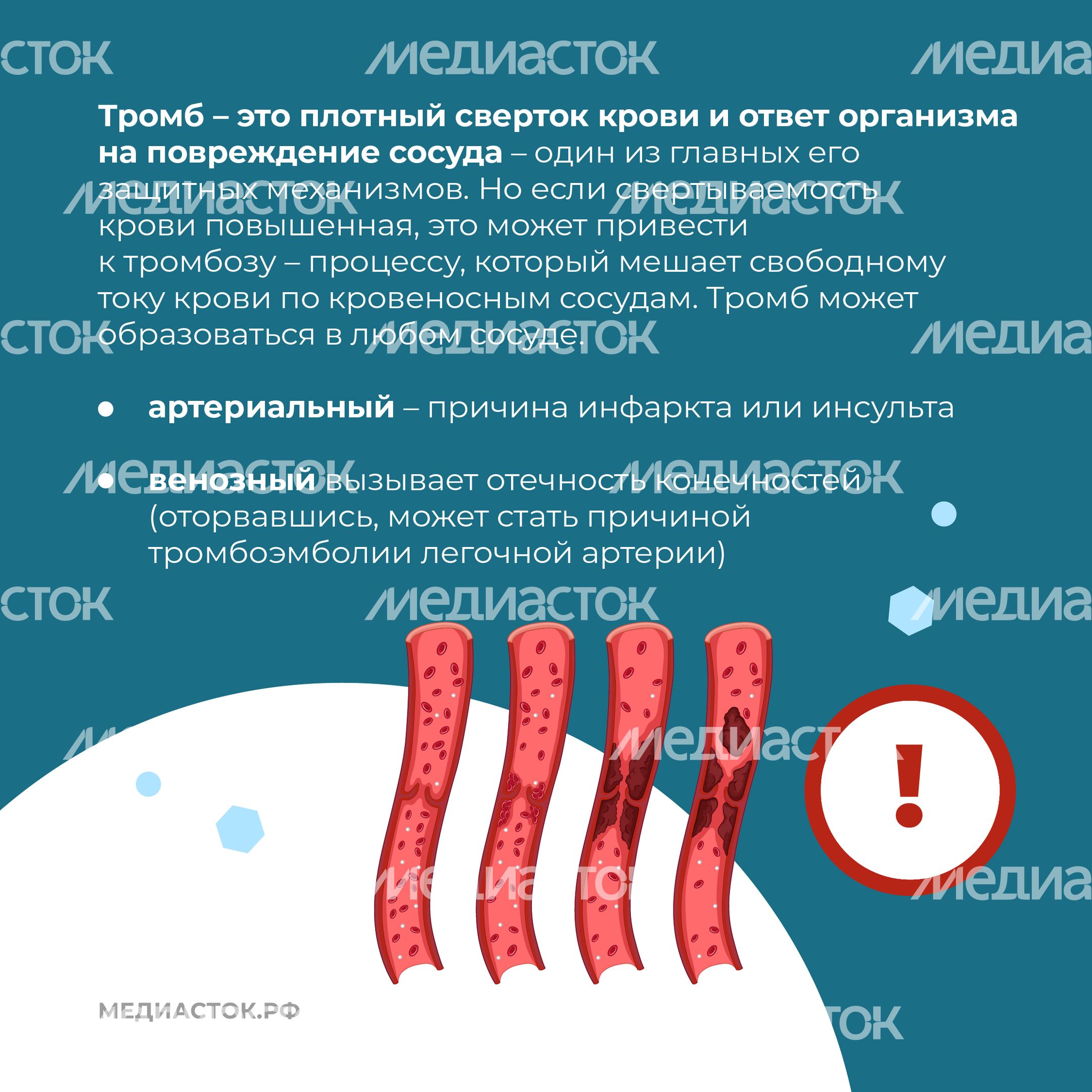 Тромбоз квадрат 03 Тромбоз квадрат 03