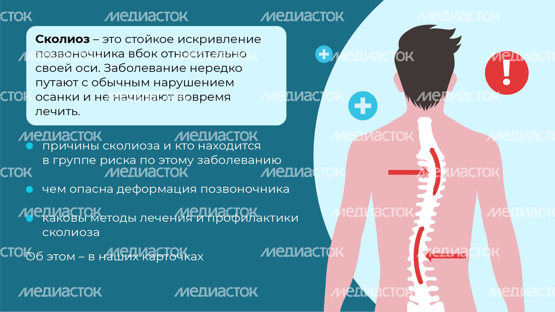 Чем опасен сколиоз горизонталь (2)