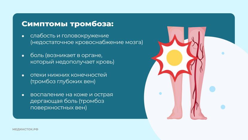 Тромбоз горизонталь 06