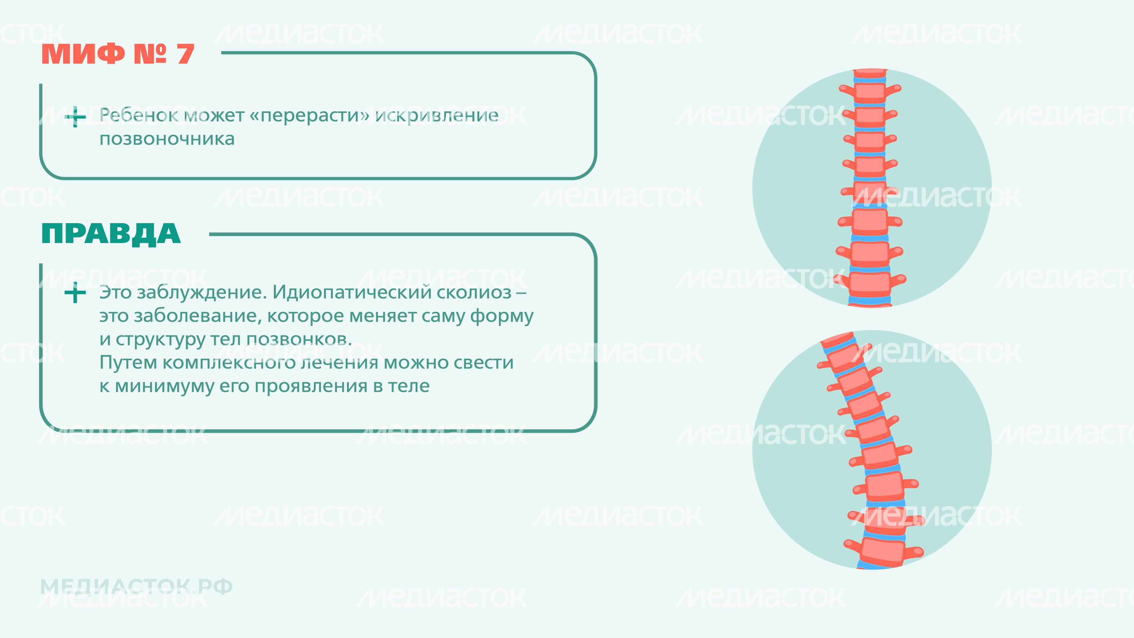 Идиопатический сколиоз мифы и правда горизонталь 07 Идиопатический сколиоз мифы и правда горизонталь 07