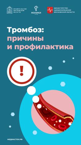 Тромбоз вертикаль 01