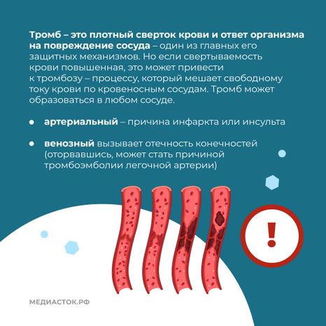 Тромбоз квадрат 03
