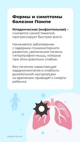 Болезнь Помпе вертикаль 04