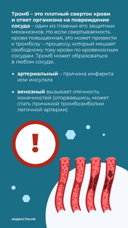 Тромбоз вертикаль 03