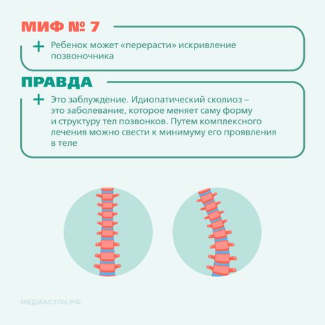 Идиопатический сколиоз мифы и правда квадрат 07