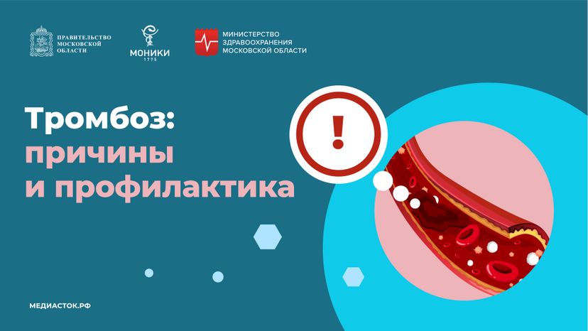 Тромбоз горизонталь 01